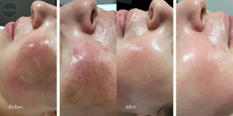 Cosmelan Pigmentation Treatments - Before and After Results